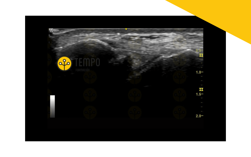 Ligamento peroneo astragalino anterior ecografia tempo formacion.png